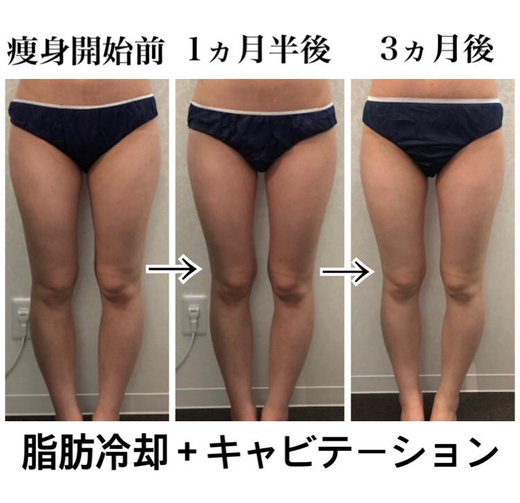 ダイエット】セルライト 脂肪消滅 超音波 脂肪消滅 痩身